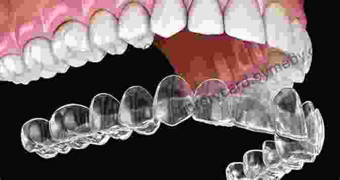 Advanced Aligner Treatment Techniques Being Demonstrated On A Dental Model, Showcasing The Management Of Complex Orthodontic Cases Principles And Biomechanics Of Aligner Treatment E