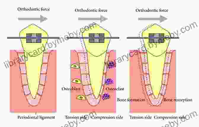 Diagram Illustrating The Biomechanics Of Tooth Movement, Showcasing The Application Of Force And Subsequent Tissue Remodeling Principles And Biomechanics Of Aligner Treatment E