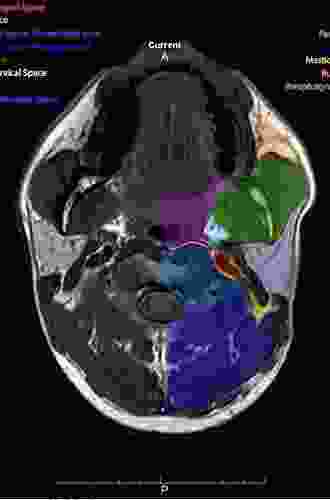 Head and Neck Imaging: Expert Consult Online and Print